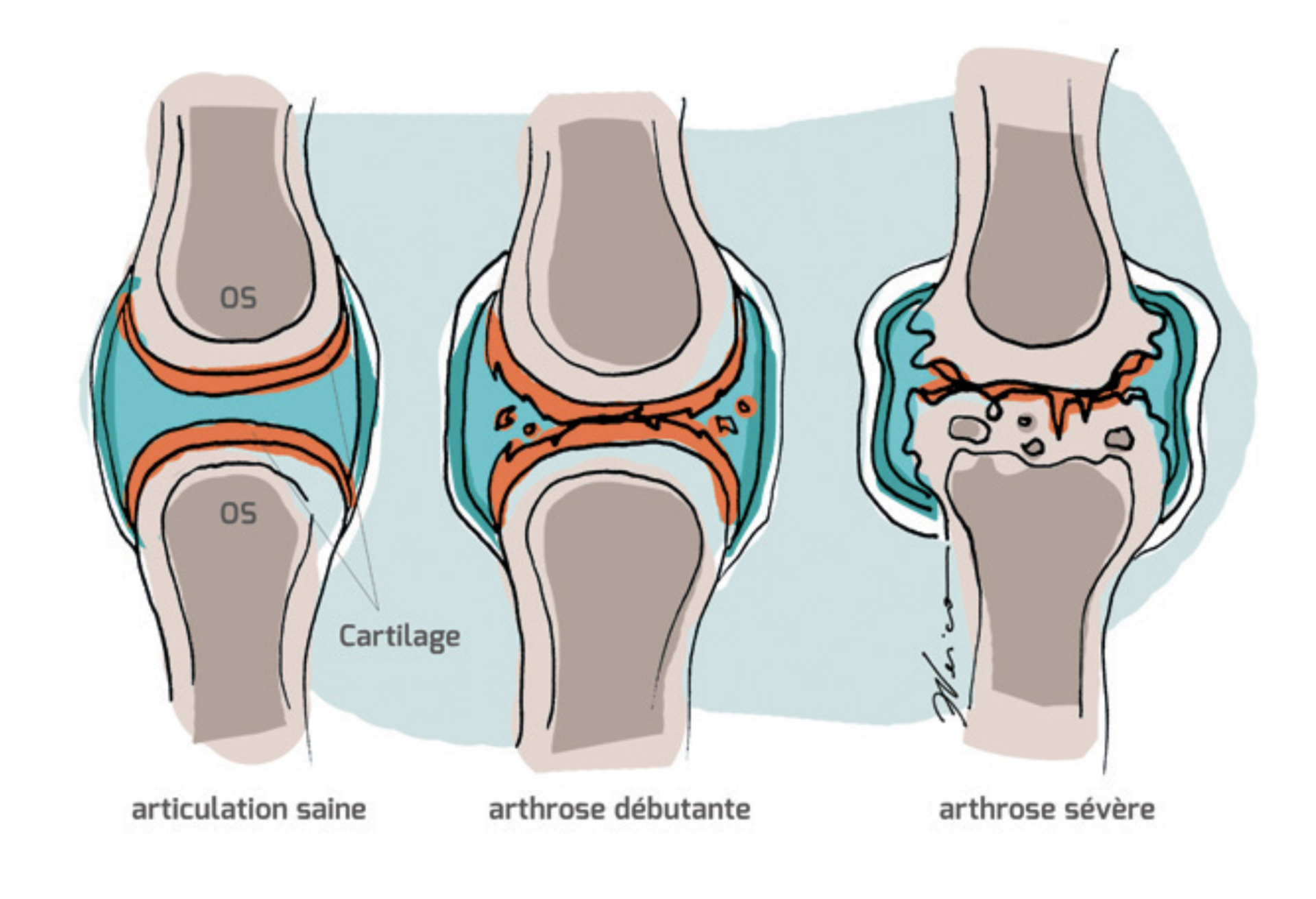 Arthrose